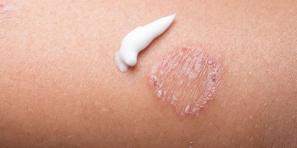 Close up of skin with dab of cream above infection.
