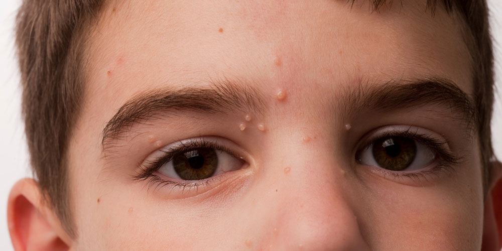 Young boy with molluscum contagiosum.